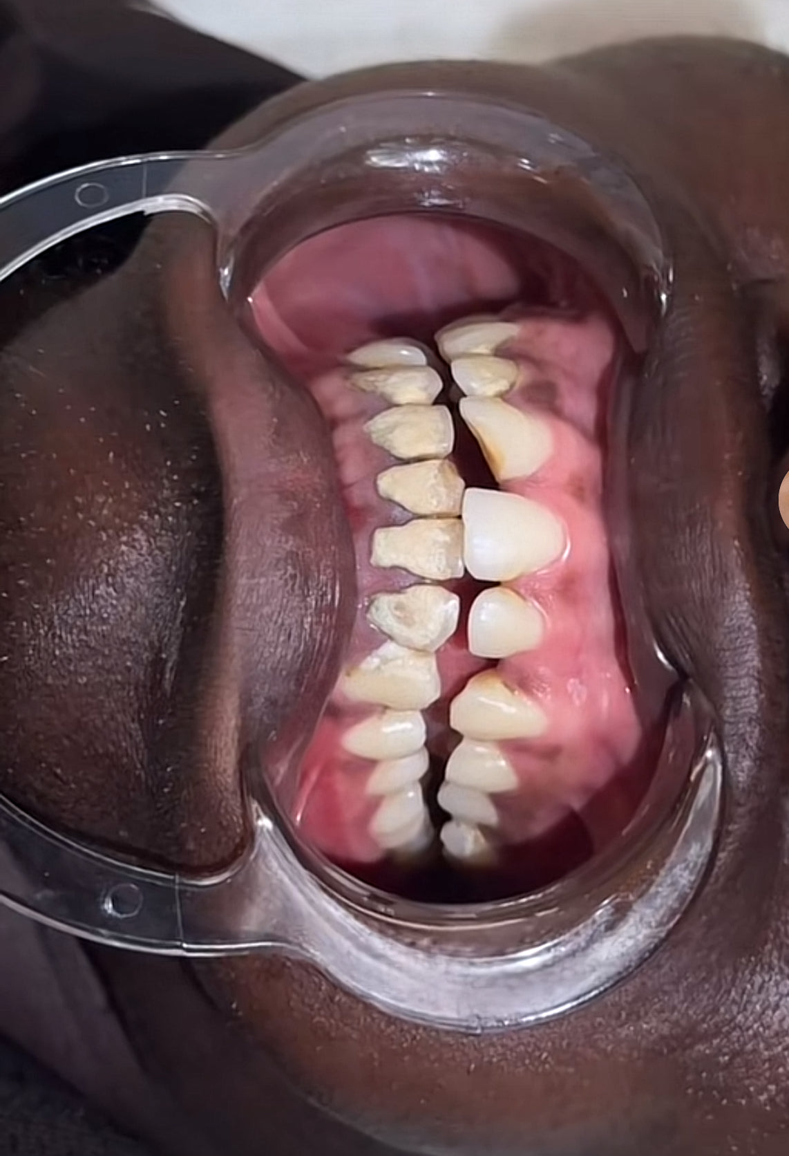 TEETH WHITENING