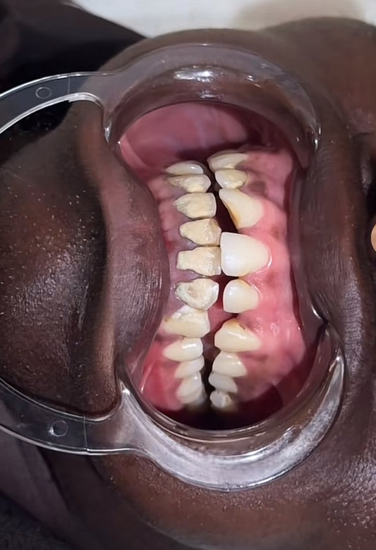 TEETH WHITENING