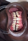 TEETH WHITENING