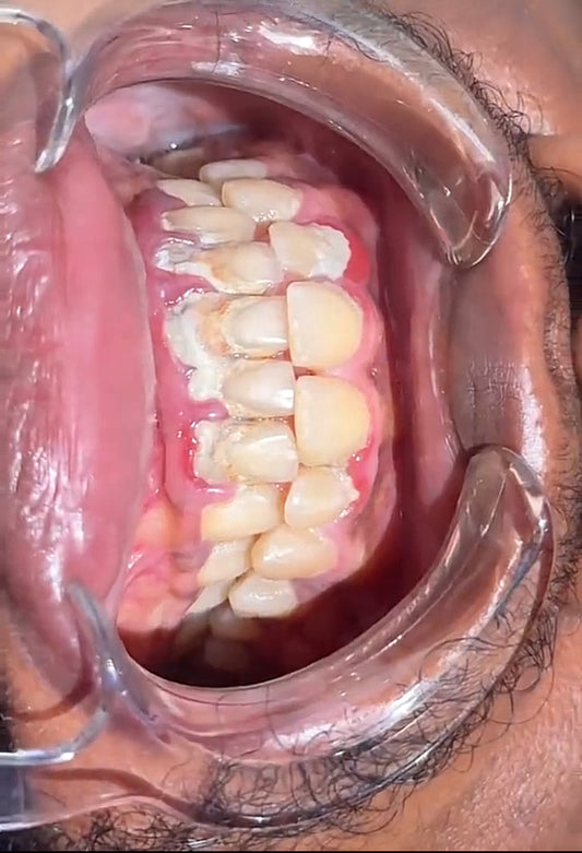 TEETH WHITENING