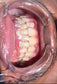 TEETH WHITENING