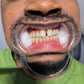 TEETH WHITENING